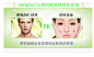 BenzacAC 5%去痘凝胶50g（5%适合中度症状痘痘）澳洲进口-tmall.hk天猫国际