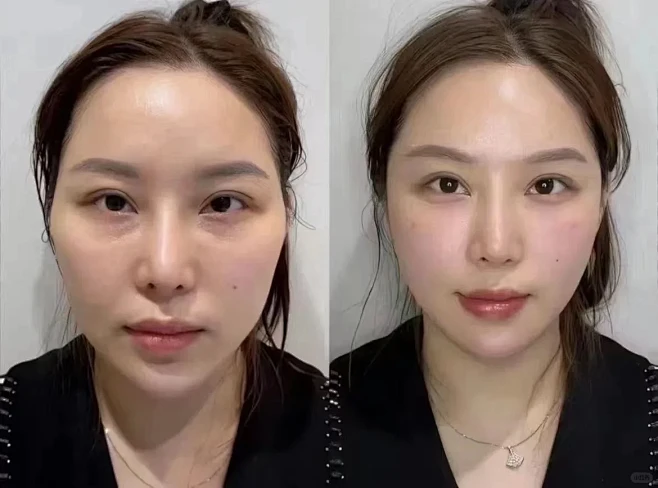 抗衰不是整容，只是让你看起来更年轻 抗衰不是整形，抗衰是在我们原有的基础上做加减法，把我们岁月留下的痕迹，流失的营养做一个填补，让我们更精致，更年轻态