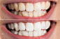 一个人,人的牙齿,女人,幸福,仅一个女人,牙龈,水平画幅,医疗流程,牙齿,人