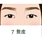 眼部问题  07