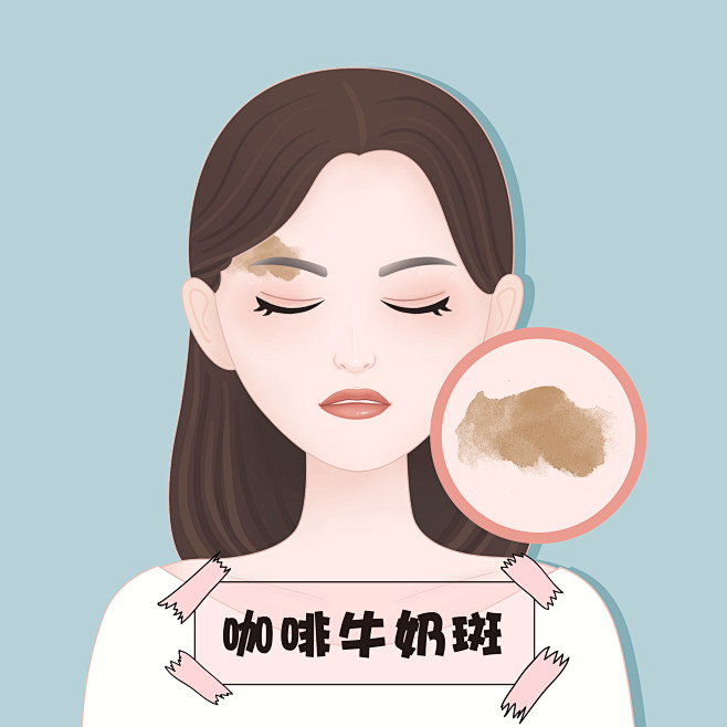 咖啡牛奶斑-胎记，斑，痣，瘤，血管瘤医美...