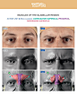 Angery eyes - Muscles of the glabellar region