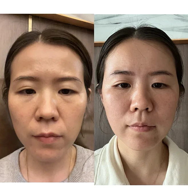 医美一年变化 - 小红书