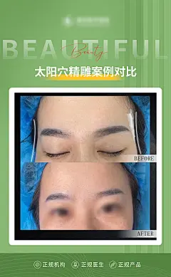 海报 医美 整形 美容 太阳穴 精雕 案例 对比 