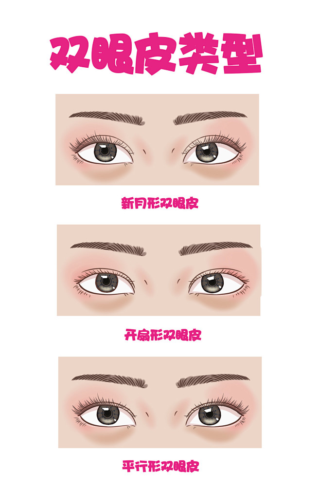 眼部 双眼皮 脸部 双眼皮手术 面部 双眼皮类型 全切双眼皮 双眼皮类型 新月型双眼皮 开扇形双眼皮 平行型双眼皮