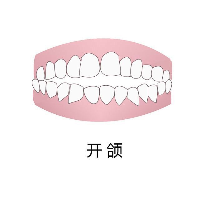 牙齿 口腔 漫画 插画 卡通 牙齿矫正 牙齿疾病 牙齿稀疏 牙齿错乱 反颌 牙列拥挤 中线不齐 开颌 牙齿缺损 深覆合 龅牙 牙齿不齐 偏颌 