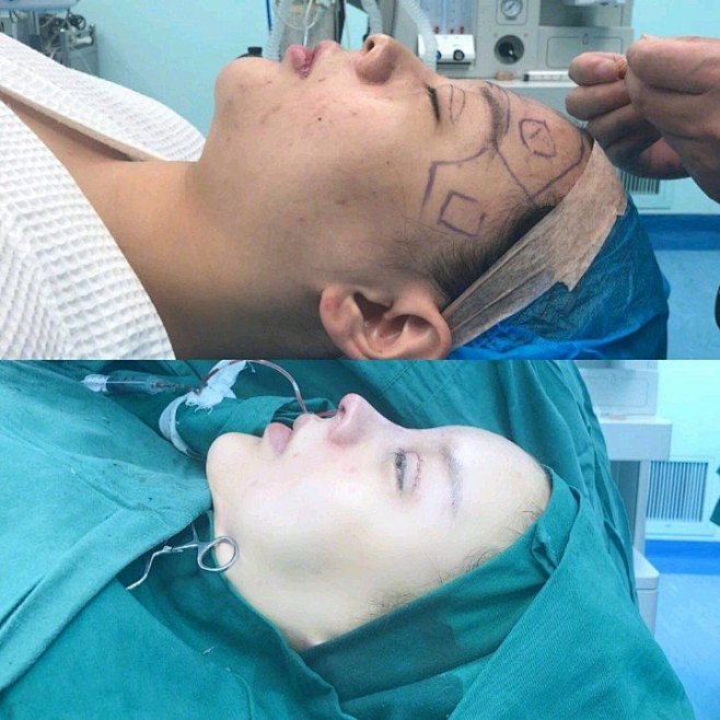 我做的项目：#双眼皮#鼻综合#抽脂#脂肪...