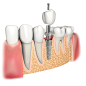 Illustrations for dental implant clinic, Alexander Zvyagintsev