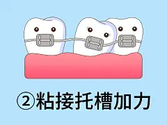 牙齿矫正爱情故事-粘接托槽（后置）
