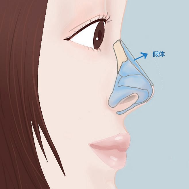 隆鼻隆鼻手术隆鼻过程