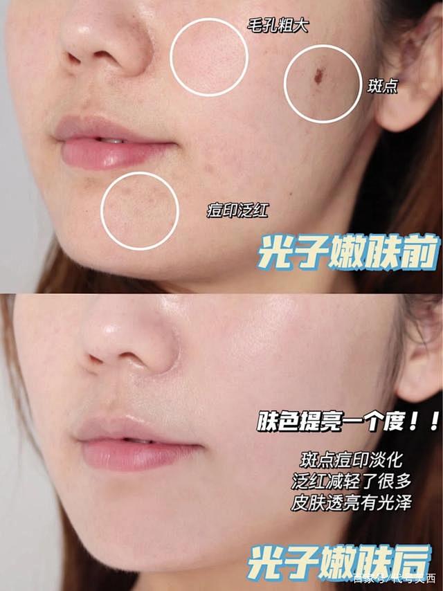 必须收藏！最近很火的m22光子嫩肤和超光...