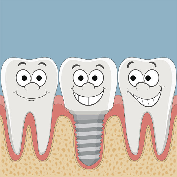 人牙齿和牙种植体。矢量图素材