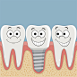 人牙齿和牙种植体。矢量图素材