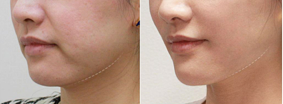 到了中年脸上皮肤下垂法令纹木偶纹严重有什么靠谱的方法可以淡化它们