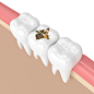 3d渲染的牙齿与牙科黄金填充图片素材-图片ID：312907084