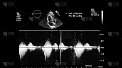 经食管超声检查心脏图像。