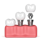 牙齿植入物在牙龈中的3d呈现器图片素材-图片ID：312480444