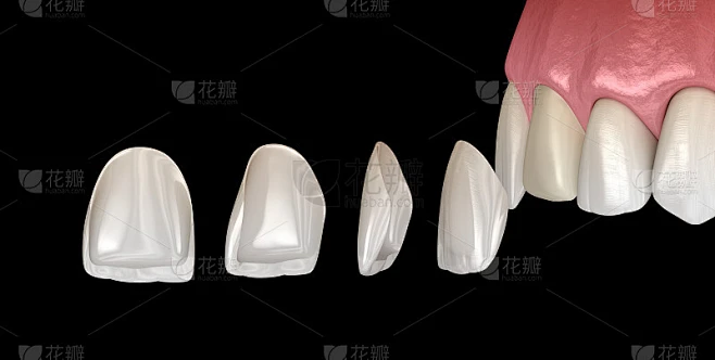 中切牙和侧切牙贴面安装程序。医学上准确的牙齿3D插图素材-花瓣网