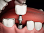 牙科种植过程的三维渲染图片素材
