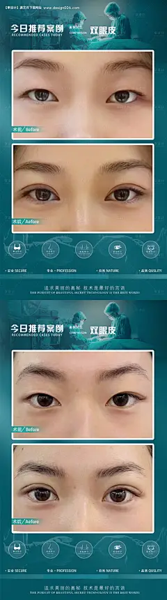 源文件下载【医美案例双眼皮海报】编号：20231123110016446
