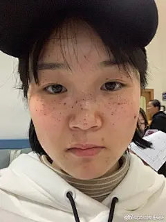 #女性激光祛斑案例分享#
来自小姐姐激光祛斑后的效果分享，希望能给你带来一些参考帮助
【色斑类型】：遗传性雀斑
【治疗方式】：光子嫩肤
【效果反馈】：十七天的时候结痂都掉完了，脸上也比之前看起来干净了很多
【博主寄语】：小姐姐的雀斑不是很严重，一次治疗的效果就很好，平时也要做好防晒工作 ​​​​...展开全文c