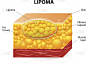 lipoma