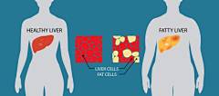 compare healthy and fatty liver, illustration detail in the human body - 脂肪肝 幅插畫檔、美工圖案、卡通及圖標