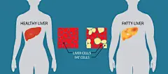 compare healthy and fatty liver, illustration detail in the human body - 脂肪肝 幅插畫檔、美工圖案、卡通及圖標