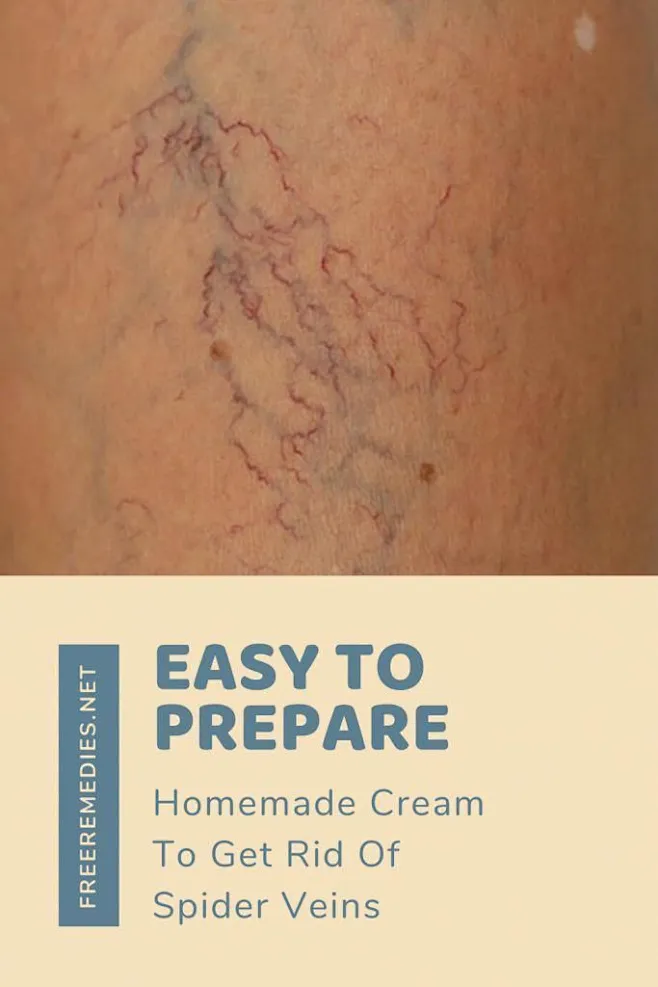 home-remedies-for-spider-veins-by-donna-campbell-this-newsletter-was