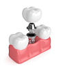 3d渲染的牙齿与种植牙图片素材-图片ID：312642069