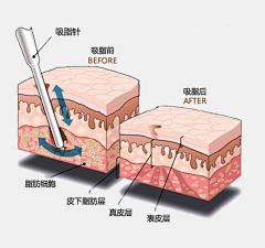 咖啡杯与筷子采集到皮肤结构