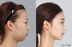 측면