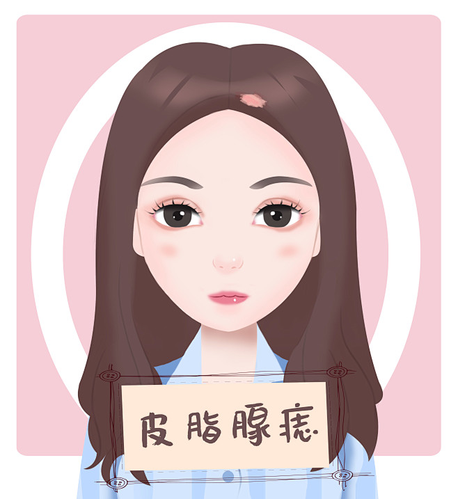 皮脂腺痣br胎记斑痣瘤血管瘤br医疗美容整形插画卡通手绘漫画可爱女孩