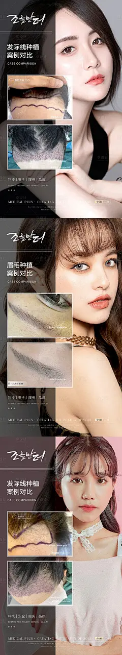 植发案例海报-源文件分享-ywjfx.cn