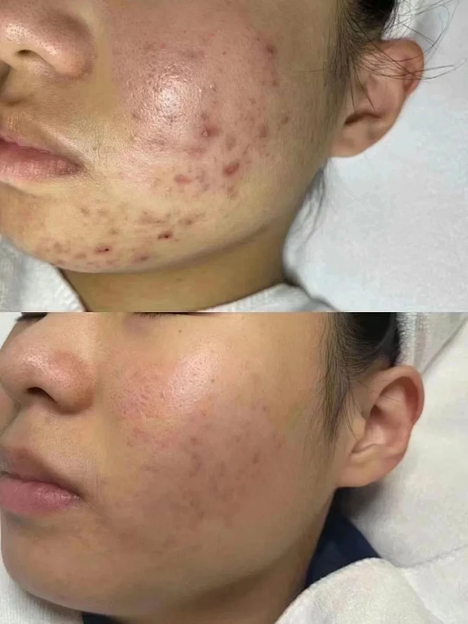 痘痘肌看过来，不猜坑