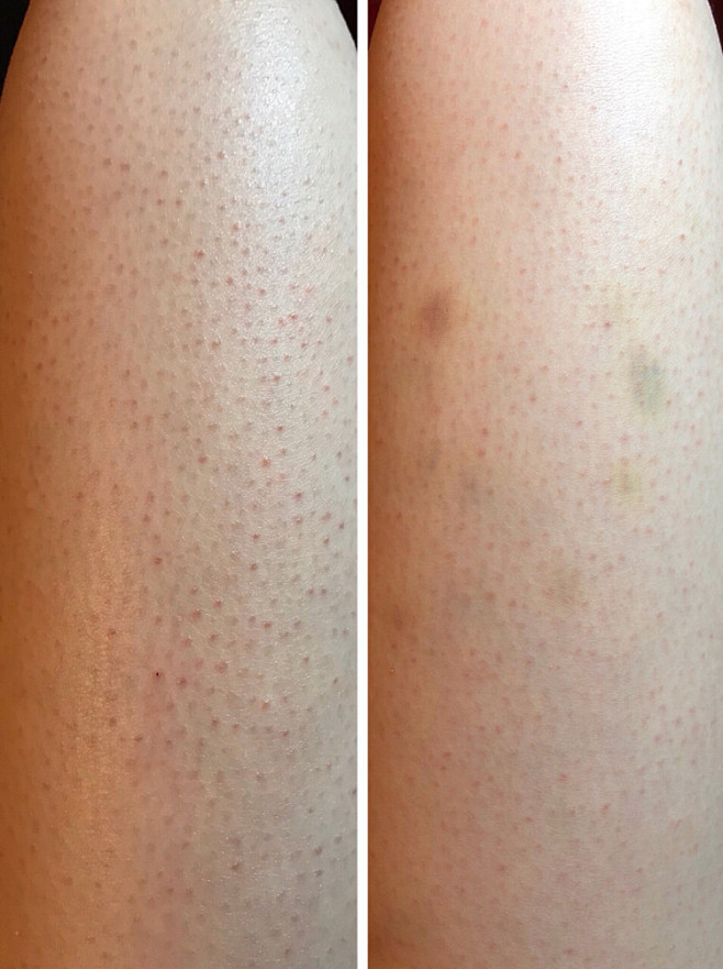 护肤去鸡皮神器alpha果酸身体乳使用一个月对比图去角质效果好的护肤