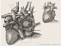 【专业组 非商业插画类】全反位心脏移植术 Heart Transplantation in Situs Inversus Totalis  一例6岁的全反位患者心脏移植的例子，需要重建镜像的系统静脉通路。接受者的心脏被放置在旁路上。注意复杂的心脏旋转，正因为如此，肺动脉转置到主动脉右侧并缝合到肺动脉袖口。接受者右侧SVC直接与 ​​​​...展开全文c