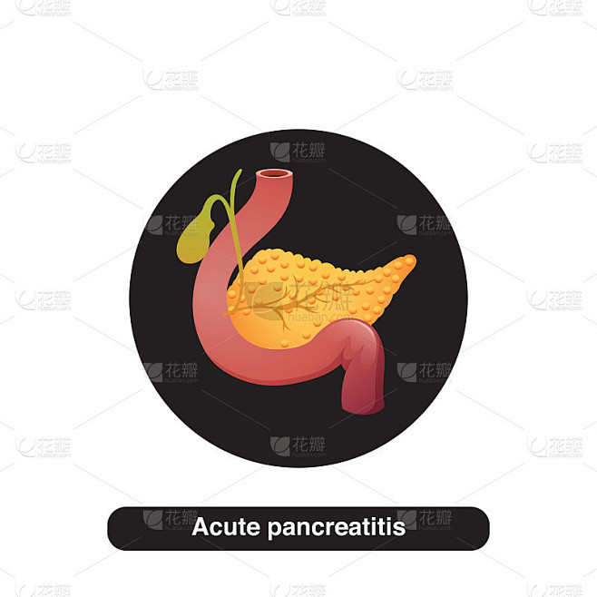 急性胰腺炎插图概念