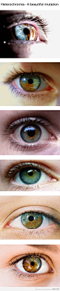 Heterochromia - a beautiful mutation of the iris. check out www.edacity.ca for more cool science facts