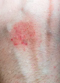 过敏病人手上有红灯芯草或湿疹。