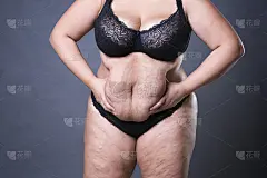 女性腹部肥胖，女性腹部超重，腹部有妊娠纹特写