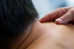 医学医疗中医养生针灸摄影图片