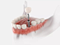 Premolar tooth implant图片素材