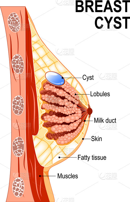囊肿,妇女问题,乳腺炎,横截面,人类腺体...