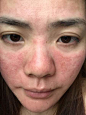 脸部泛红的搜索结果_百度图片搜索