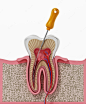 3d illustration of root canal treatment process