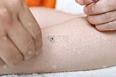 治疗和艾灸
