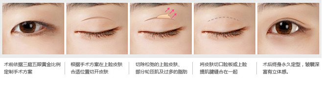 切开双眼皮过程