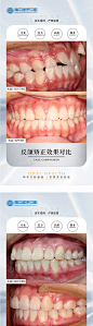 医疗牙科矫正案例海报-源文件