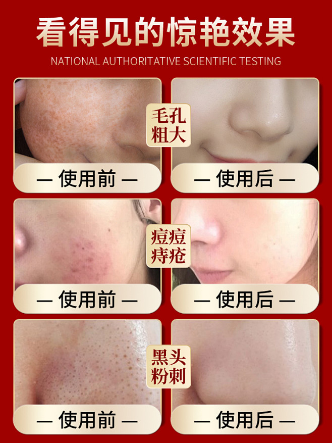 水杨酸刷酸祛痘面部收缩毛孔粗大精华液果酸...